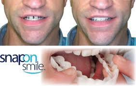 Last Day Sale 49% OFF🔥Artificial Teeth/ silicon braces/ Artificial teeth